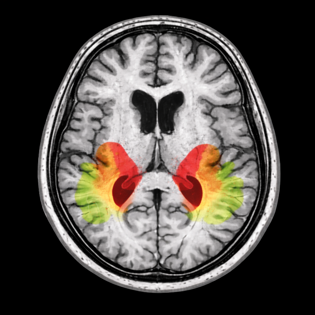 Brain MRI scan